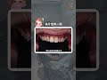琢白美學牙醫診所 | Raw原生貼片 | 陶瓷貼片 | 美白貼片 | 15