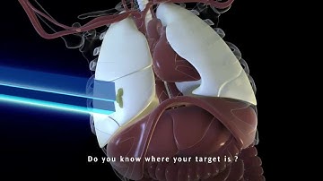 Symmetry - Managing Respiratory Motion