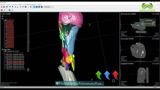 Ooopds - Surgical Planning -Shoulder 1