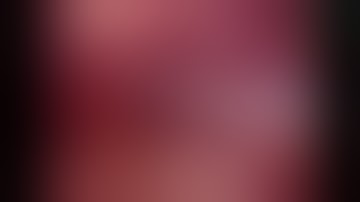 Laparoscopic Excision of type - 1 Choledochal Cyst with Hepaticojejunostomy  Jejunojejunostomy