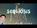 Scoliosis - Dr. Gary Sy "Interactive Live"
