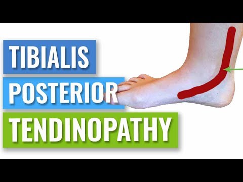 Video: Hilft Physiotherapie bei Tendinitis tibialis posterior?