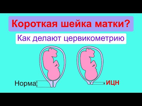 Короткая шейка матки по УЗИ. Как делают цервикометрию при беременности.