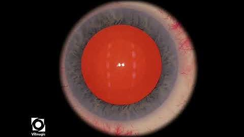 EyeSi CAT B IOL Insertion, Level 3 (insert spheric IOL)