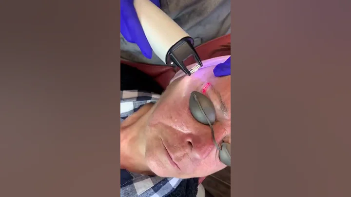 Fraxel 1550 skin resurfacing with Nordlys