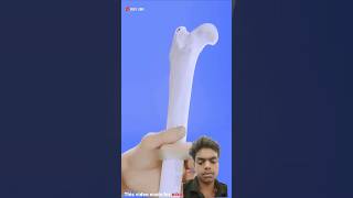 What If Your Bone Becomes A Splinter 😳#shorts #shortsfeed