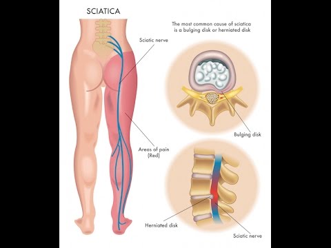 साइटिका क्या है?