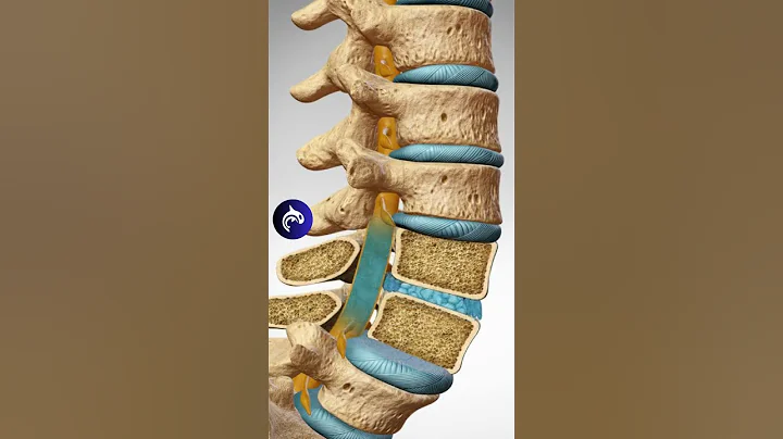 See How Spondylolisthesis Affects the Spine - DayDayNews