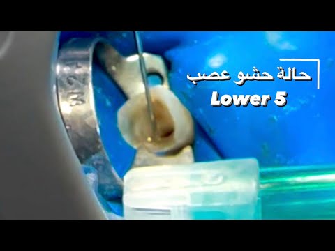 علاج الجذور شرح حالة حشو عصب سن