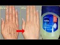 3 दिन में हाथो की झुर्रियां दूर कर सॉफ्ट और सूंदर हाथ पायें-Remove Wrinkle From Hands/Skin Treatment