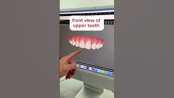 How we designed this patient’s smile transformation with Invisalign to straighten the front teeth