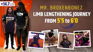 MR. BROKENBONES LIMB LENGTHENING JOURNEY FROM 5‘5 TO 6‘0