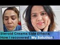 How I Recovered From Steroid cream Side Effects || My Experience || Stop using Hydroquinone
