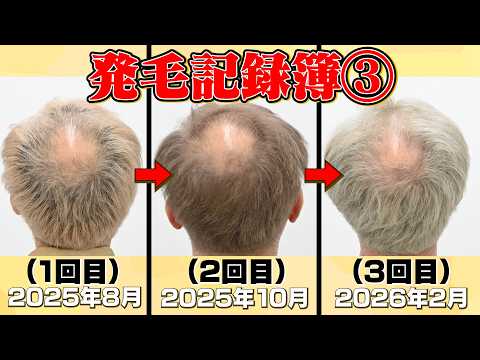 【岩尾のAGA】発毛率97.9%の最新レーザーの記録【ドキュメント】