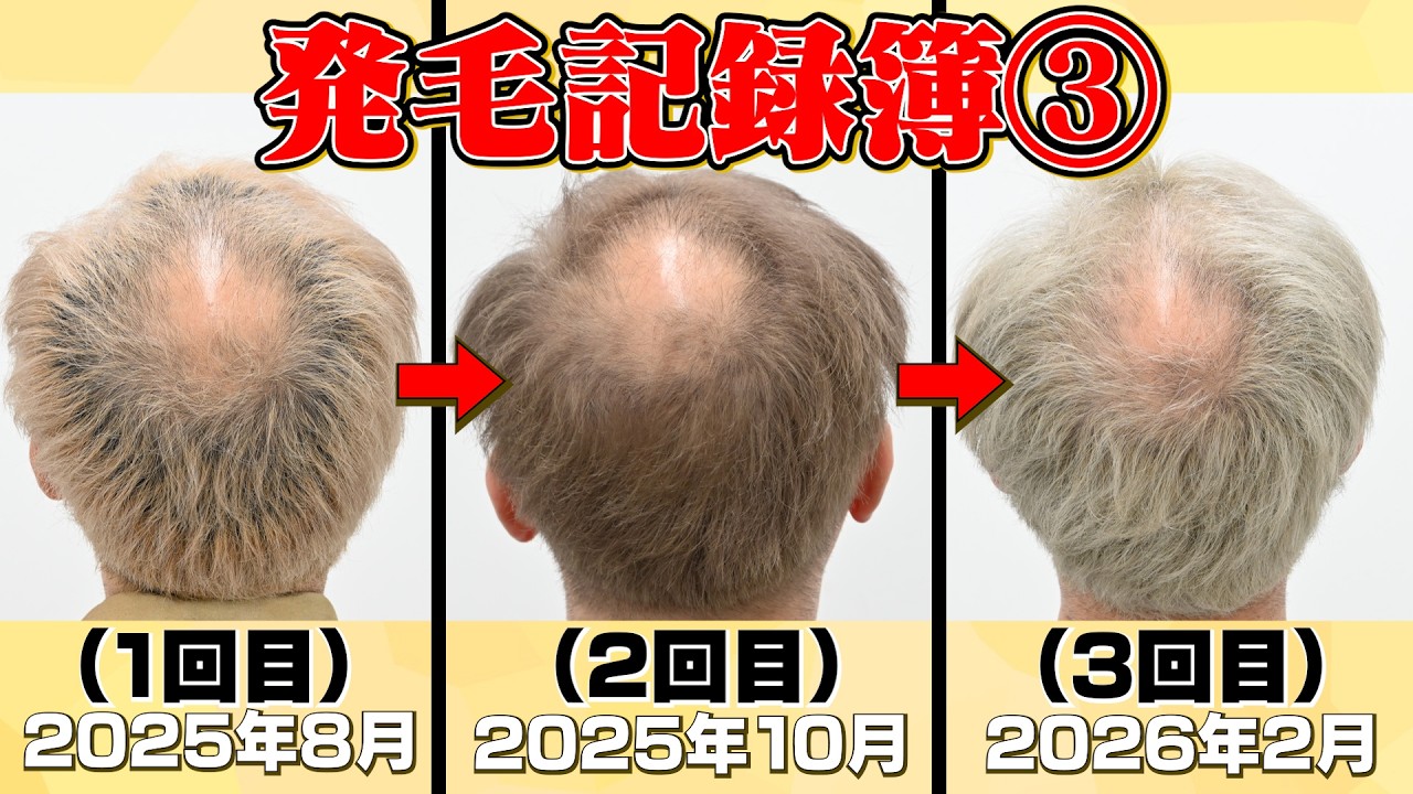 【岩尾のAGA】発毛率97.9%の最新レーザーの記録【ドキュメント】