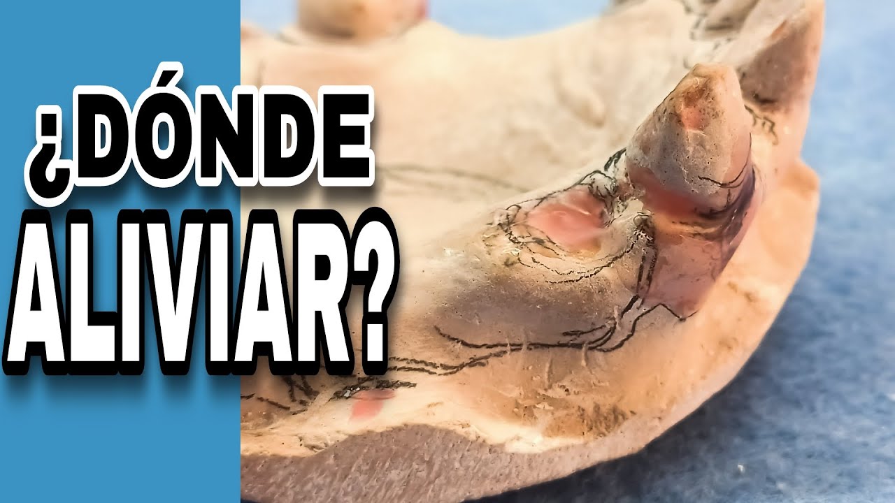 ZONAS DE ALIVIO PARA UNA PRÓTESIS DENTAL FLEXIBLE