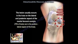 Osteochondritis Dissecans Of The Knee - Everything You Need To Know - Dr. Nabil Ebraheim