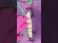 Orthodontic treatment with composite resin restoration dentist shorts