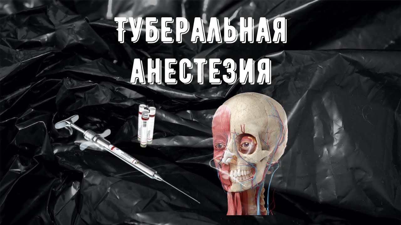 Туберальная анестезия