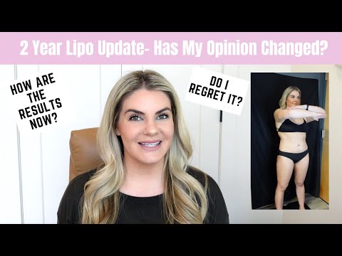 Lipo Update: 2 years- Do I regret it? How Are The Results?