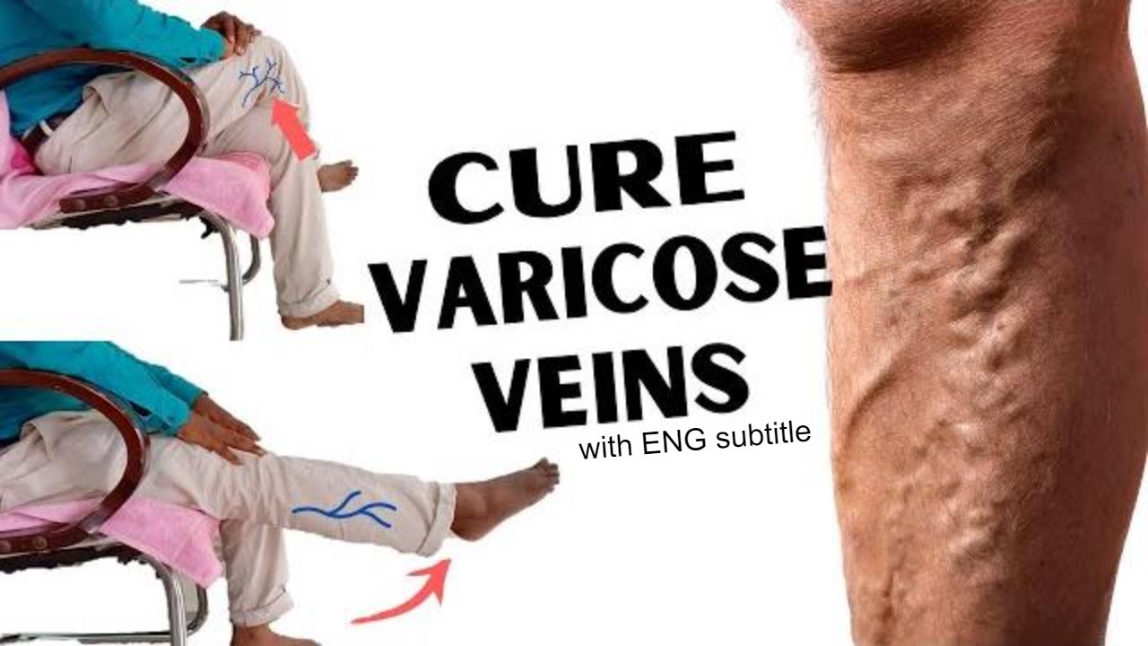 exerciii în vene varicoase cu gantere picioarele venelor varicoza