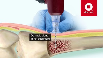 Intraosseous infusion | Doczero E-learning