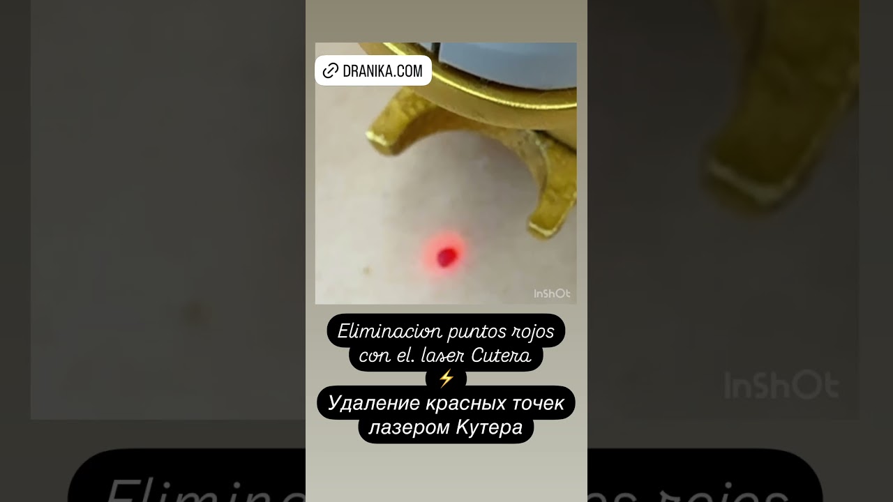 Láser Vascular estrellas arañas vasculares Удаление красных точек сосудов сосудистых звездочек Лазер