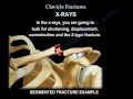 Clavicle Fractures - Everything You Need To Know - Dr. Nabil Ebraheim