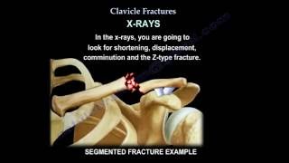 Clavicle Fractures - Everything You Need To Know - Dr. Nabil Ebraheim