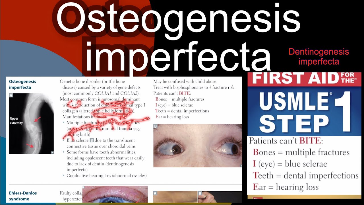 Osteogenesis imperfecta Dentinogenesis imperfecta in Hindi/Urdu by