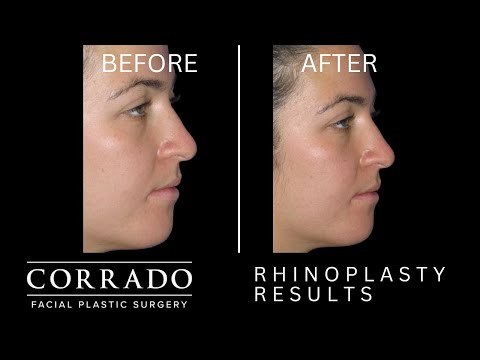 Video thumbnail: One Week Results After Nose Job Surgery | Dr. Anthony Corrado · Dr. Anthony Corrado
