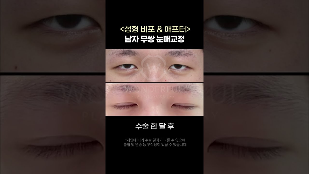 [Вондэрфул Гоо Сайхны Мэс Заслын Эмнэлэг] Одоо үед эрэгтэйчүүдийн давхраатай зовхины мэс засал ингэж хийгддэг!