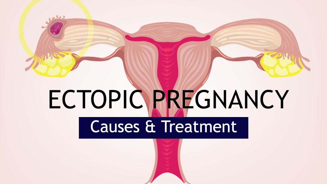 write an essay on ectopic pregnancy