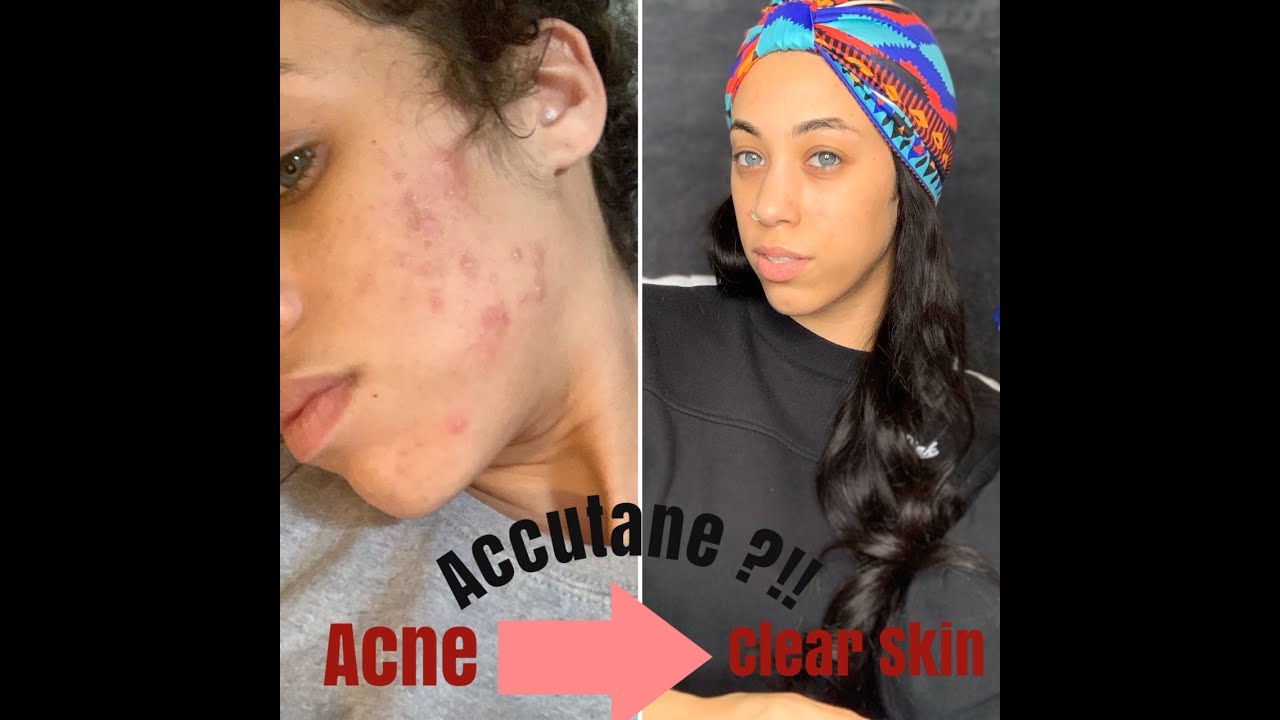 ACCUTANE?! My Journey To Clearing Cystic Acne! - YouTube