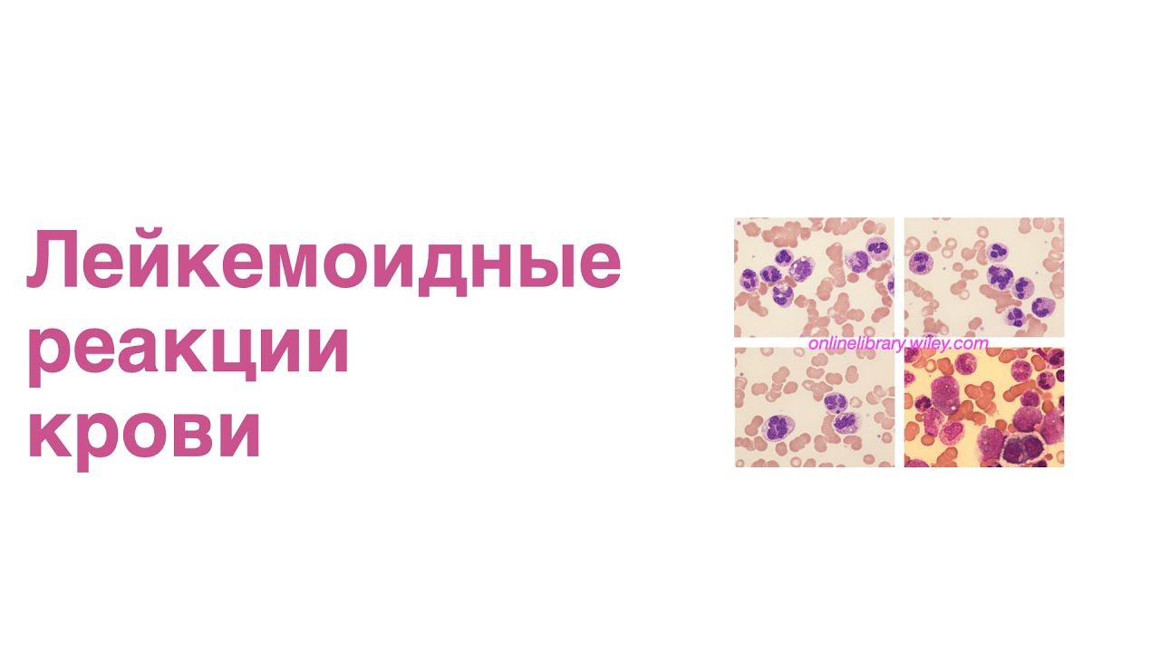 Лейкемоидные реакции крови
