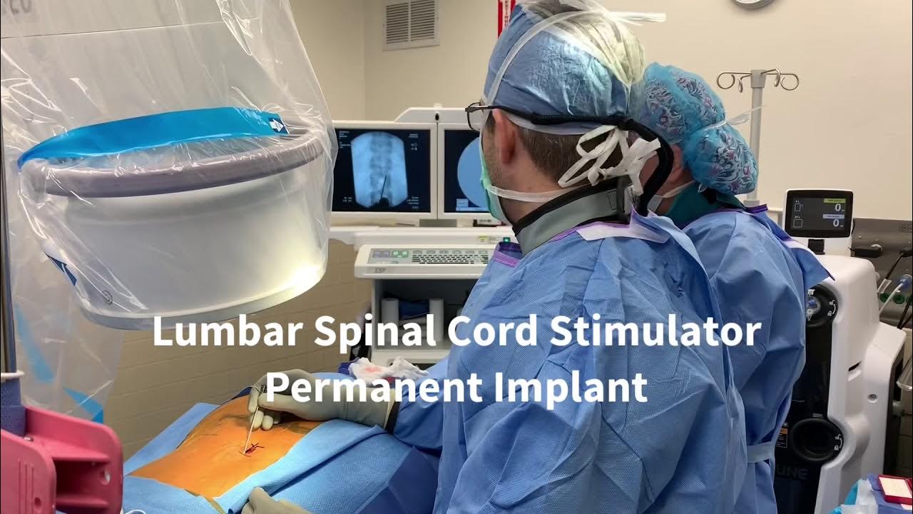 How to perform a lumbar spinal cord stimulator permanent implant youtube