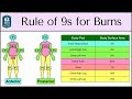 Rule of nines for burns made easy adult  baby calculation emt nursing