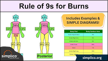 Rule of Nines for Burns MADE EASY: Adult & Baby Calculation [EMT, Nursing]
