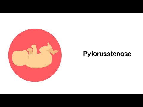 Pylorusstenose - Kinderkrankheiten