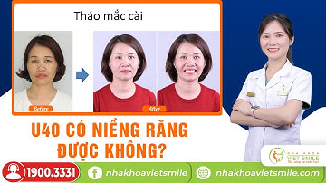 U40 có niềng răng được không? Phân tích case niềng răng hô