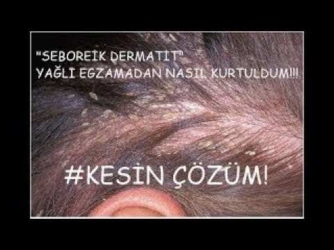 Seboreik Dermatit Den Nasil Kurtuldum Youtube