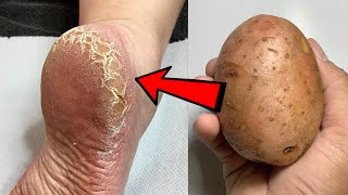 Eliminate Cracked Heels and get White and Smooth Feet \/ Magic Cracked Heels home remedy