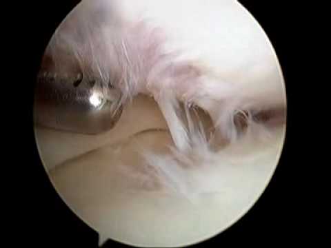 Arthroscopic Surgery Doesn't Help With Arthritis Knee Pain