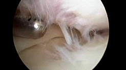 Knee Arthritis.mp4