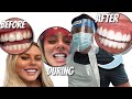 GETTING VEENERS DONE! Smile Transformation | Sabrina Nicole