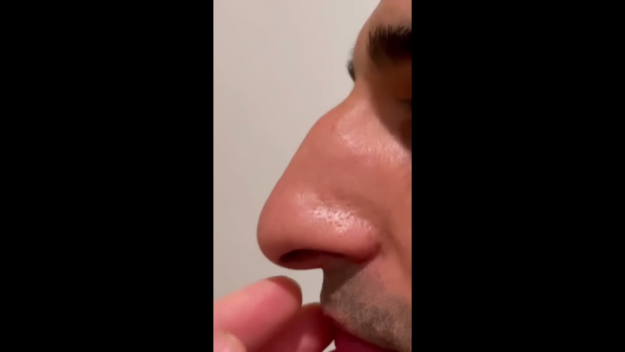 Male Rhinoplasty Before After Shorts