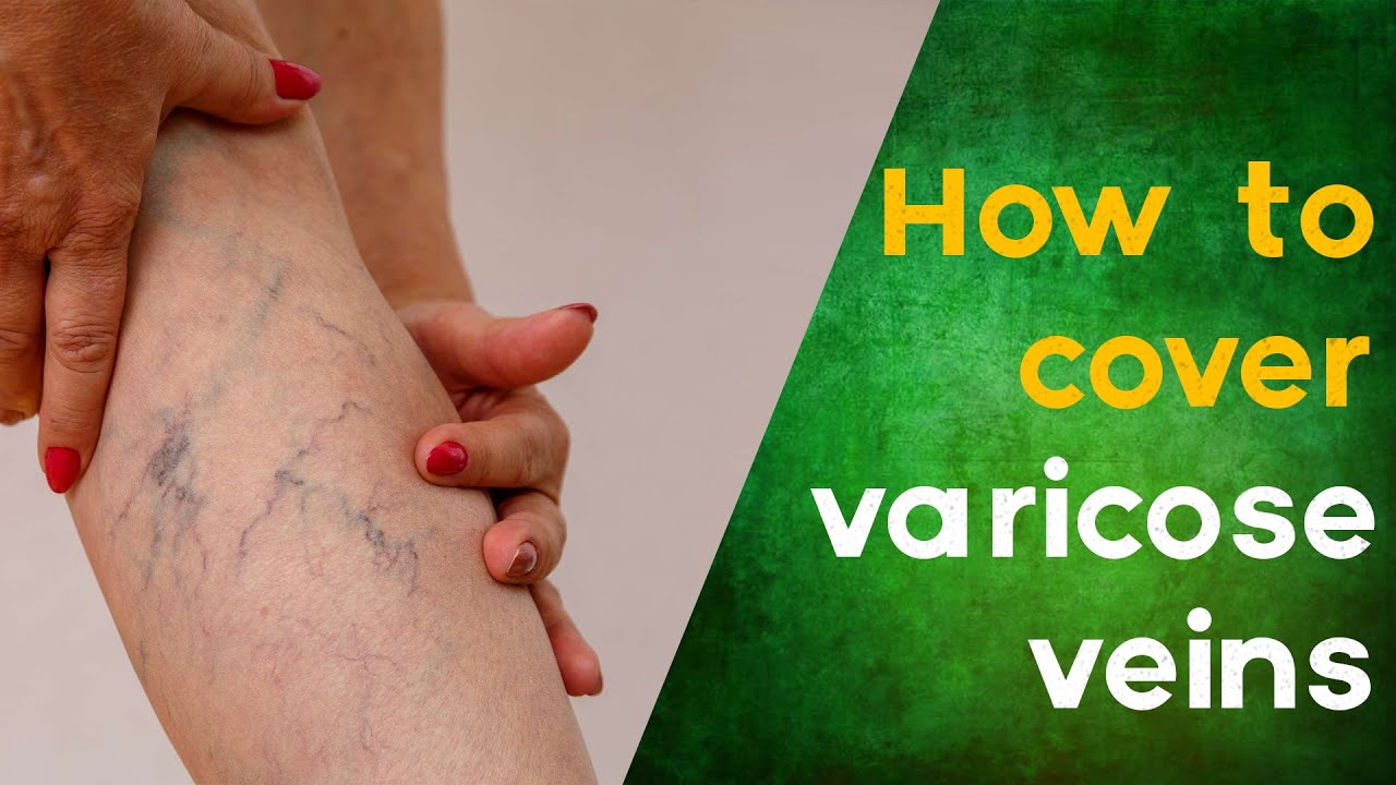 Er Varicose Veins