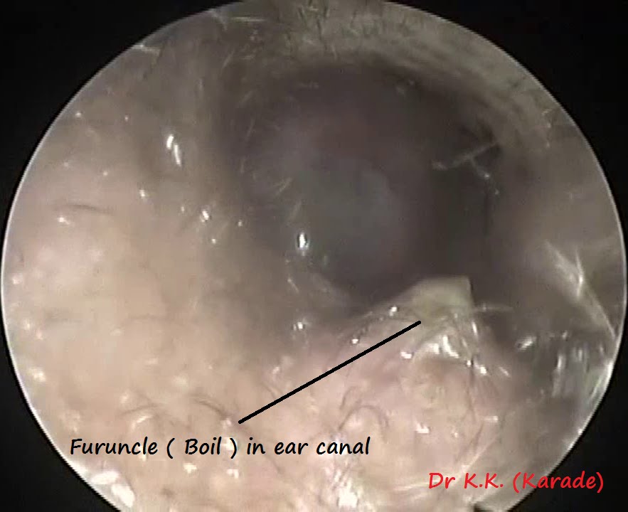 Oto-endoscopy : Furuncle ( Boil ) in ear canal - YouTube