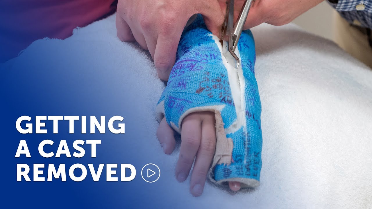 Cast Comfort: Get help & relief for your itchy, smelly cast - DryCAST