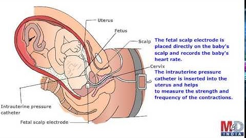 Electronic Fetal Monitoring